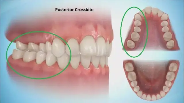 Image showing what a posterior crossbite is