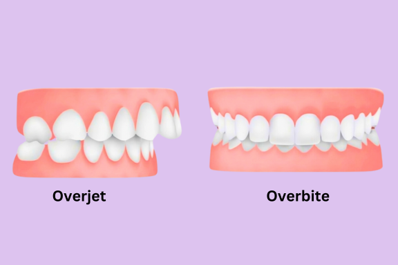 comparison between overjet and overbite teeth