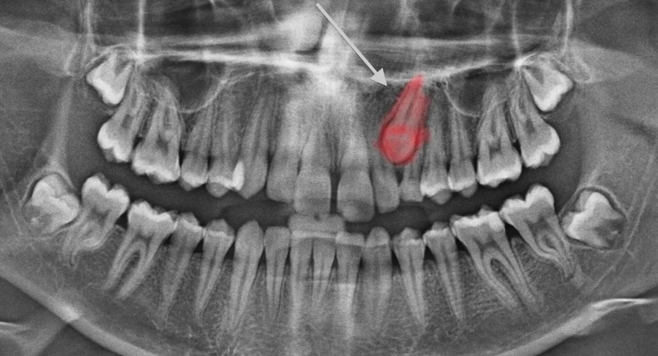 impacted eye teeth shown on a panoramic radiograph