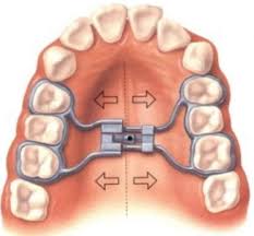 palate expander for adults shown on a dental model