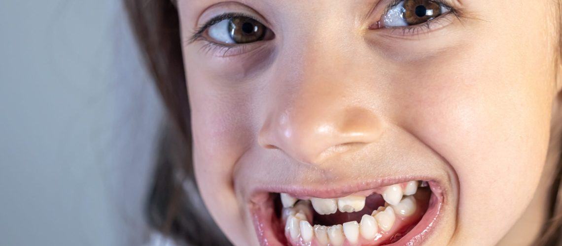 Kid smiling with lower jaw forward