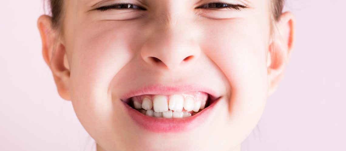 Girl smiling with crooked teeth