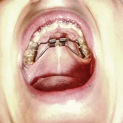 A photo of a mouth with a palatal expander glued to the upper jaw via the teeth