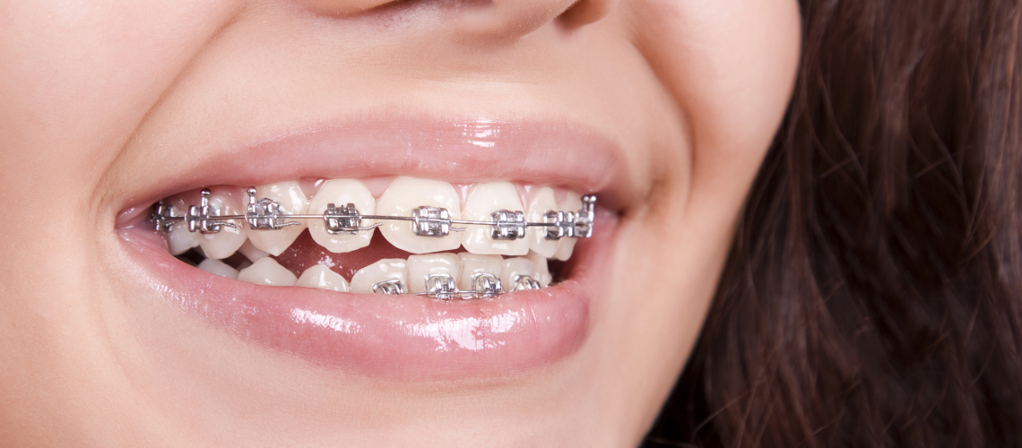 traditional braces